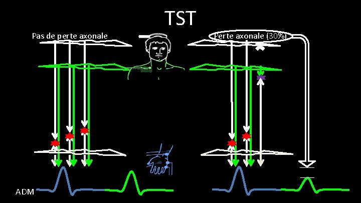 Pas de perte axonale ADM TST Perte axonale (30%) 