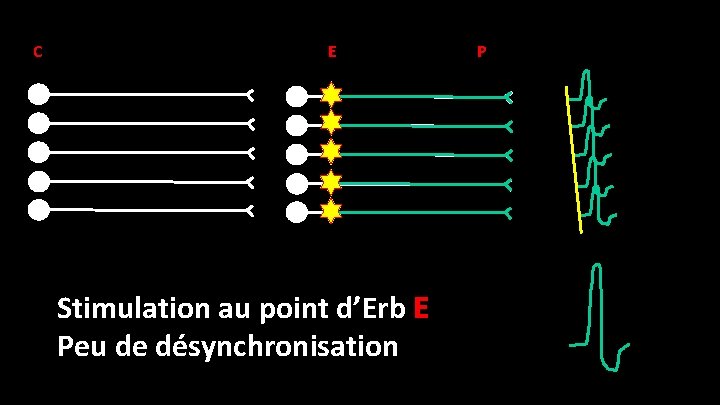 C E Stimulation au point d’Erb E Peu de désynchronisation P 