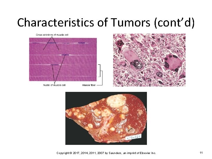 Characteristics of Tumors (cont’d) Copyright © 2017, 2014, 2011, 2007 by Saunders, an imprint