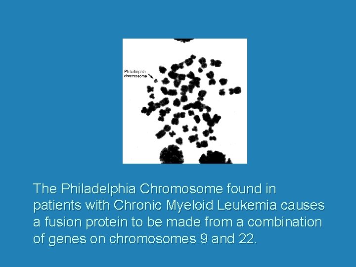 The Philadelphia Chromosome found in patients with Chronic Myeloid Leukemia causes a fusion protein