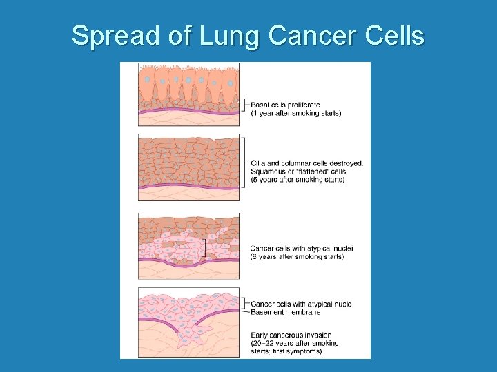 Spread of Lung Cancer Cells 