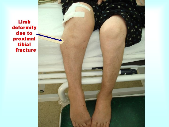 Limb deformity due to proximal tibial fracture 
