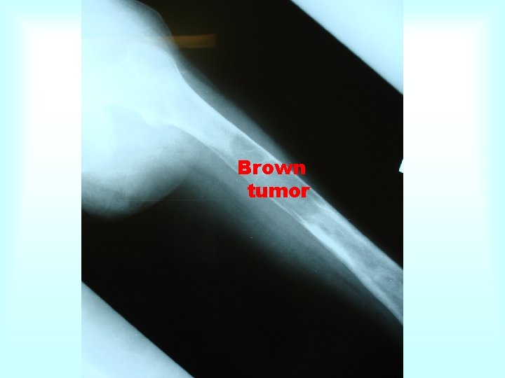 Brown tumor 