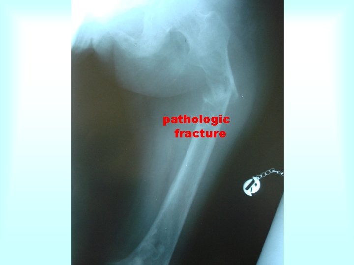 pathologic fracture 