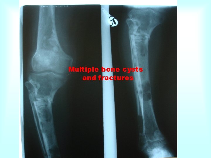 Multiple bone cysts and fractures 