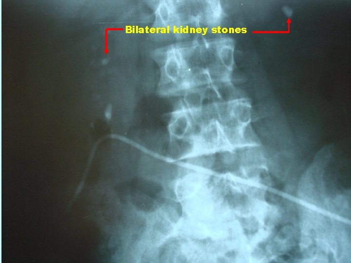 Bilateral kidney stones 