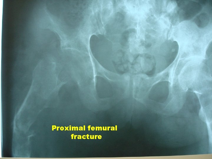 Proximal femural fracture 