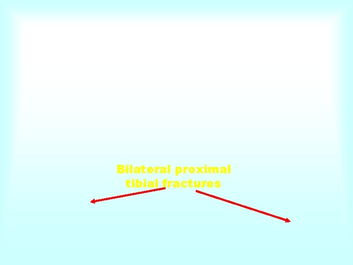 Bilateral proximal tibial fractures 