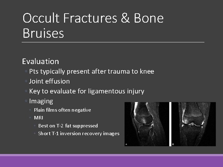 Occult Fractures & Bone Bruises Evaluation ◦ Pts typically present after trauma to knee