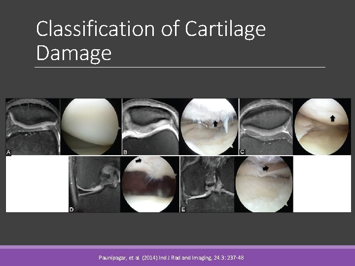 Classification of Cartilage Damage Paunipagar, et al. (2014) Ind J Rad and Imaging, 24.