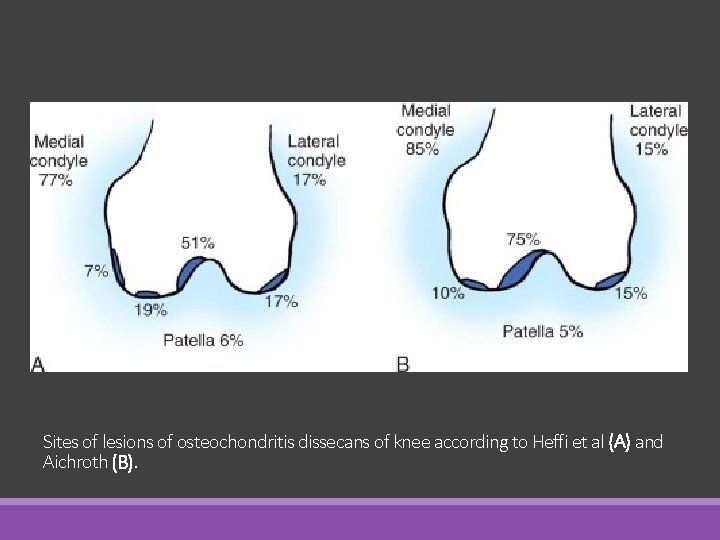 Sites of lesions of osteochondritis dissecans of knee according to Heffi et al (A)