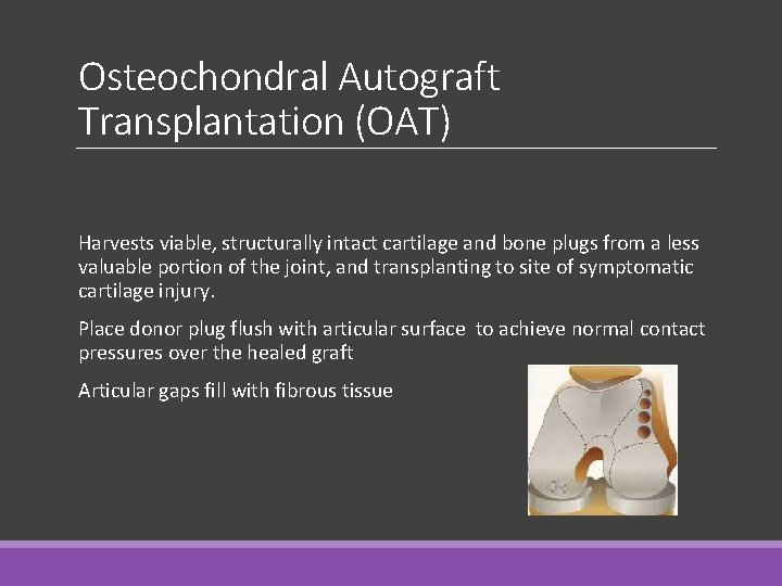 Osteochondral Autograft Transplantation (OAT) Harvests viable, structurally intact cartilage and bone plugs from a