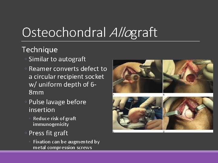 Osteochondral Allograft Technique ◦ Similar to autograft ◦ Reamer converts defect to a circular