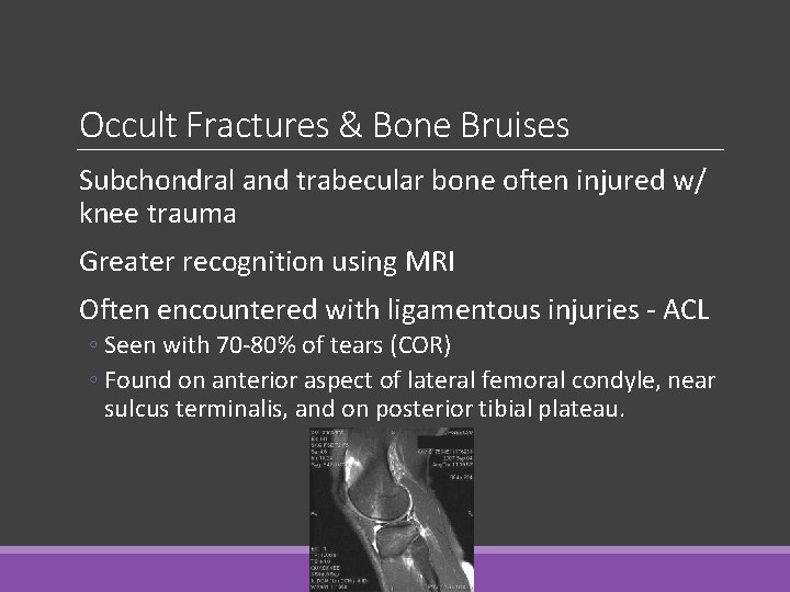 Occult Fractures & Bone Bruises Subchondral and trabecular bone often injured w/ knee trauma