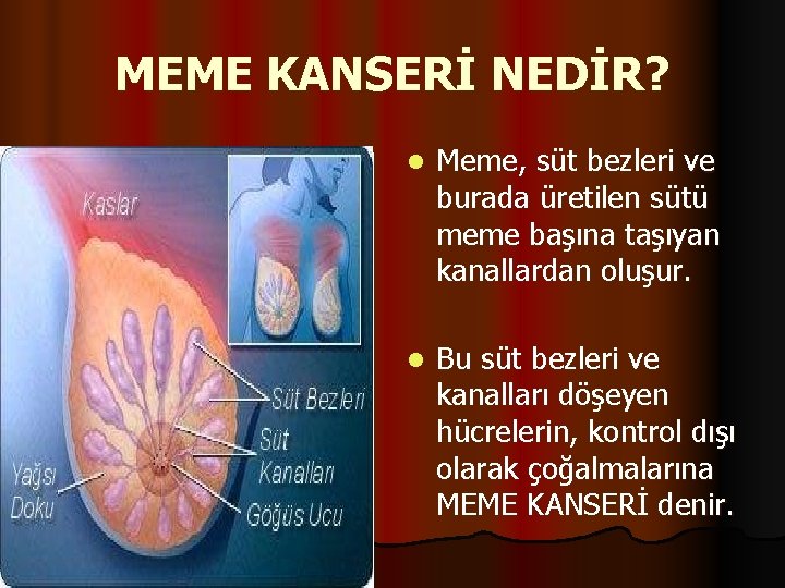 MEME KANSERİ NEDİR? l Meme, süt bezleri ve burada üretilen sütü meme başına taşıyan