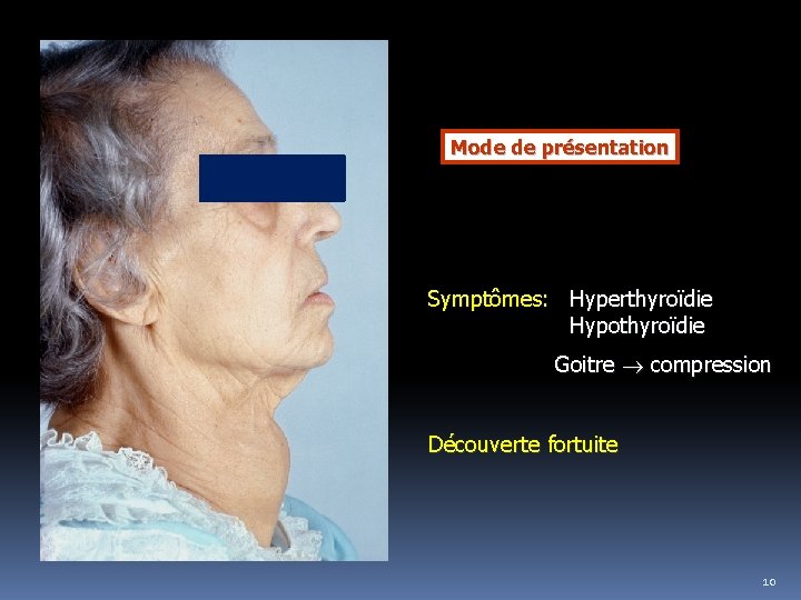 Mode de présentation Symptômes: Hyperthyroïdie Hypothyroïdie Goitre compression Découverte fortuite 10 