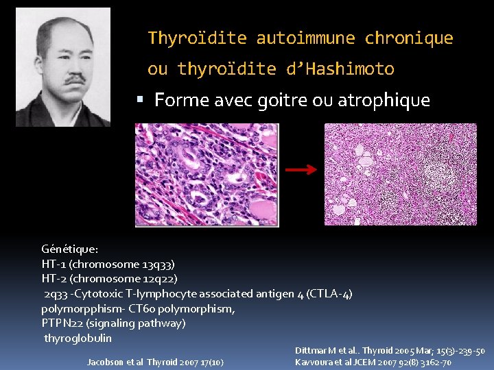 Thyroïdite autoimmune chronique ou thyroïdite d’Hashimoto Forme avec goitre ou atrophique Génétique: HT-1 (chromosome