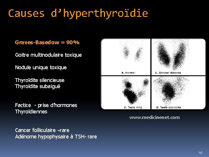 Causes d’hyperthyroïdie Graves-Basedow = 90% Goitre multinodulaire toxique Nodule unique toxique Thyroïdite silencieuse Thyroïdite