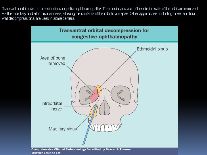 Transantral orbital decompression for congestive ophthalmopathy. The medial and part of the inferior walls