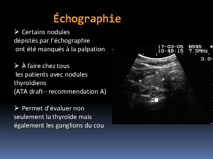 Échographie Ø Certains nodules dépistés par l’échographie ont été manqués à la palpation Ø