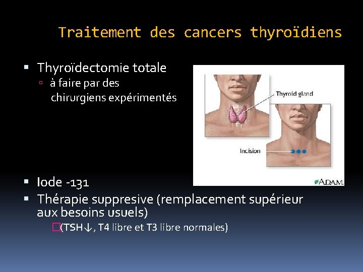 Traitement des cancers thyroïdiens Thyroïdectomie totale à faire par des chirurgiens expérimentés Iode -131