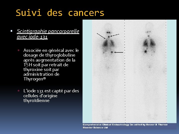 Suivi des cancers Scintigraphie pancorporelle avec iode-131 Associée en général avec le dosage de