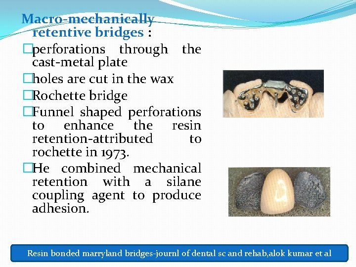 Macro-mechanically retentive bridges : �perforations through the cast-metal plate �holes are cut in the