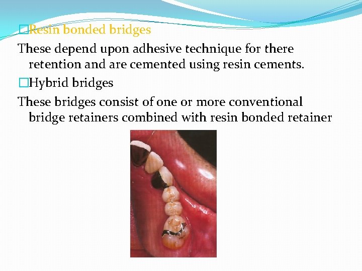 �Resin bonded bridges These depend upon adhesive technique for there retention and are cemented