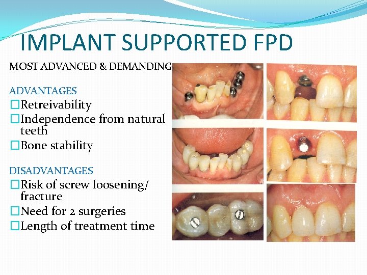 IMPLANT SUPPORTED FPD MOST ADVANCED & DEMANDING ADVANTAGES �Retreivability �Independence from natural teeth �Bone