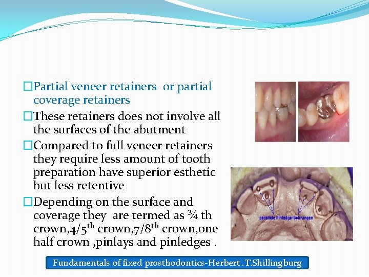 �Partial veneer retainers or partial coverage retainers �These retainers does not involve all the