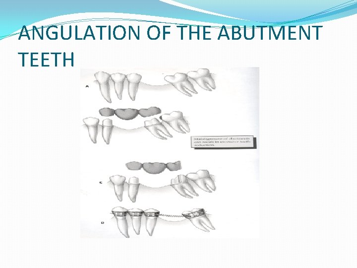 ANGULATION OF THE ABUTMENT TEETH 