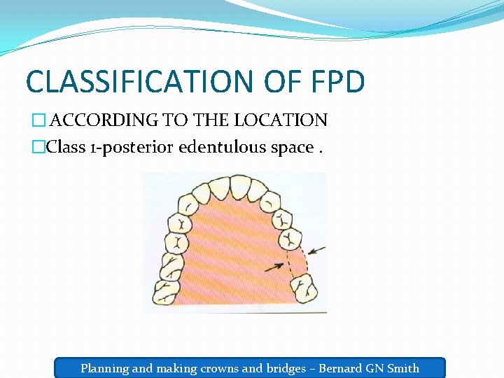 CLASSIFICATION OF FPD � ACCORDING TO THE LOCATION �Class 1 -posterior edentulous space. Planning