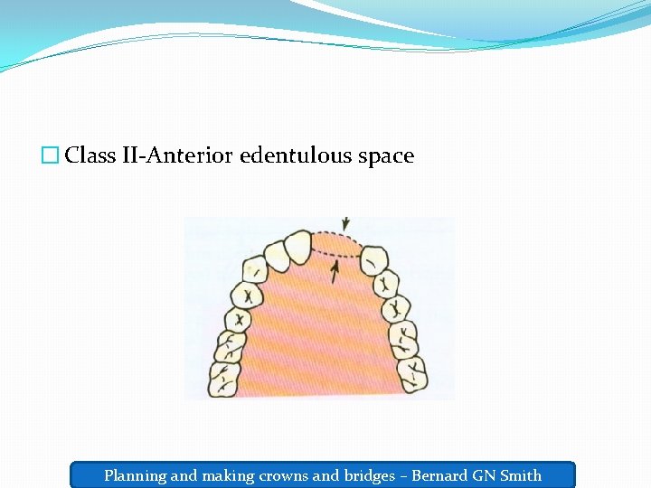 � Class II-Anterior edentulous space Planning and making crowns and bridges – Bernard GN