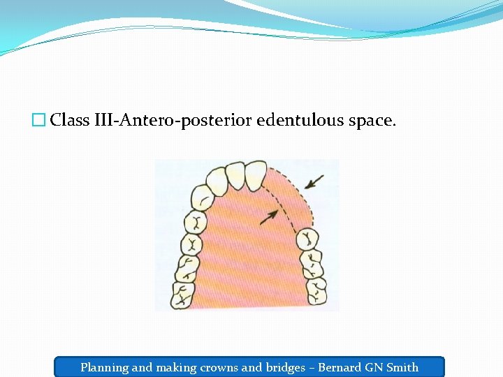� Class III-Antero-posterior edentulous space. Planning and making crowns and bridges – Bernard GN