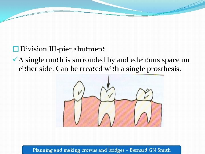 � Division III-pier abutment ü A single tooth is surrouded by and edentous space