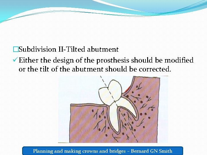 �Subdivision II-Tilted abutment ü Either the design of the prosthesis should be modified or