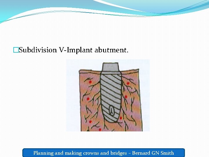 �Subdivision V-Implant abutment. Planning and making crowns and bridges – Bernard GN Smith 