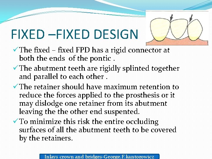 FIXED –FIXED DESIGN ü The fixed – fixed FPD has a rigid connector at