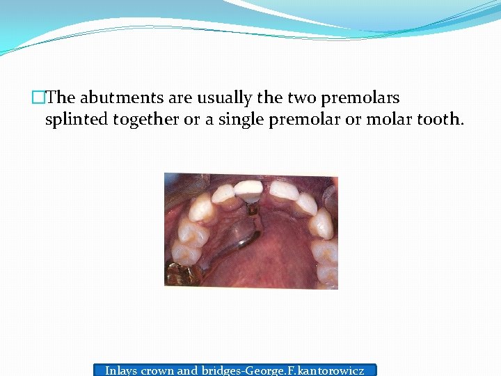 �The abutments are usually the two premolars splinted together or a single premolar or