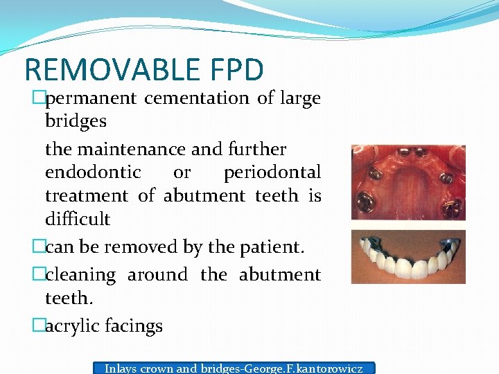 REMOVABLE FPD �permanent cementation of large bridges the maintenance and further endodontic or periodontal