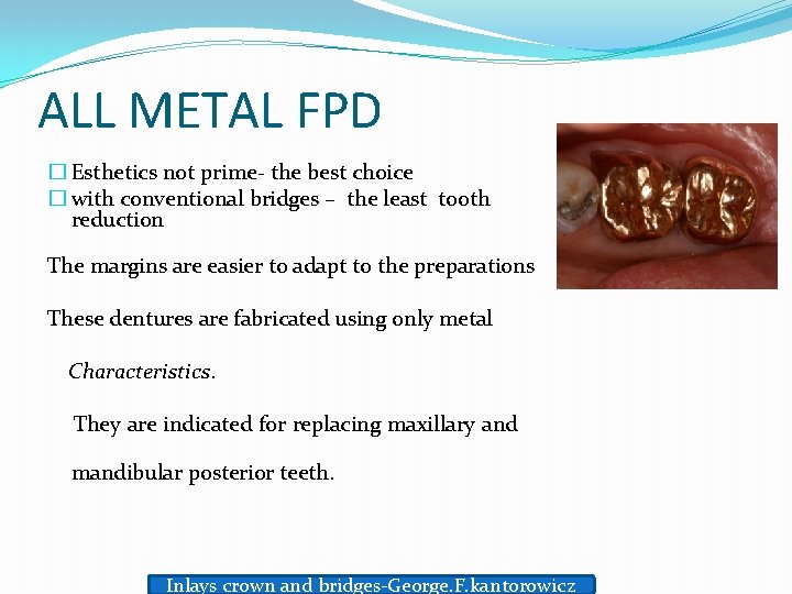 ALL METAL FPD � Esthetics not prime- the best choice � with conventional bridges