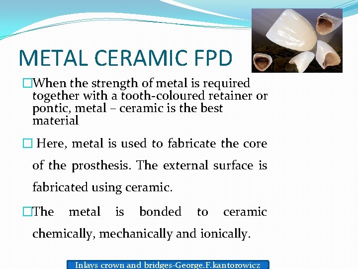 METAL CERAMIC FPD �When the strength of metal is required together with a tooth-coloured