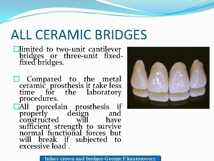ALL CERAMIC BRIDGES �limited to two-unit cantilever bridges or three-unit fixed bridges. � Compared