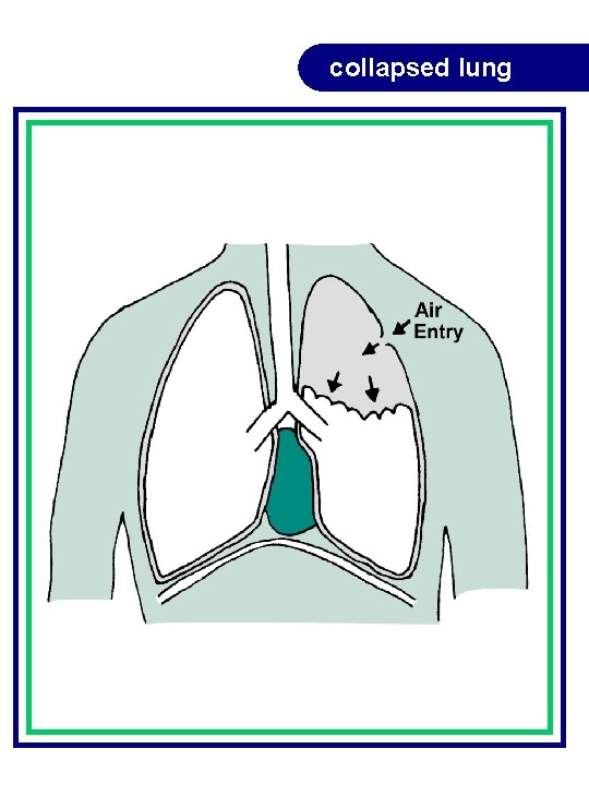 collapsed lung collapsed lung
