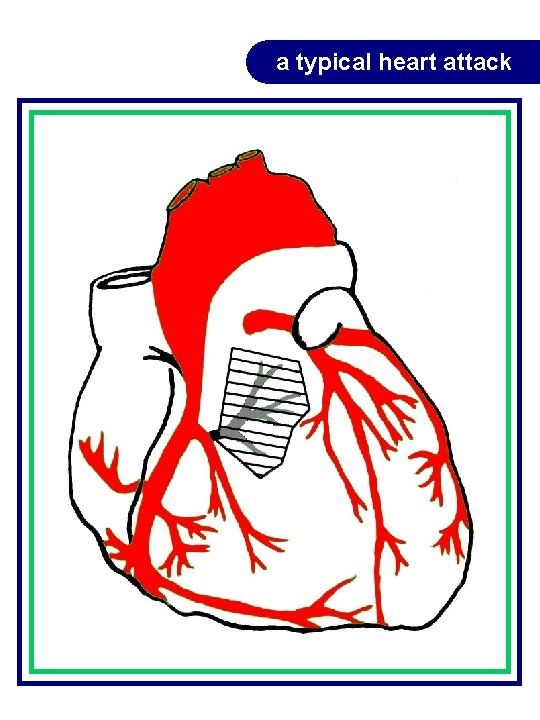 a typical heart attack a typical heart attack
