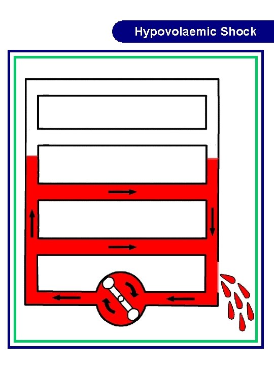 Hypovolaemic Shock Hypovolaemic Shock