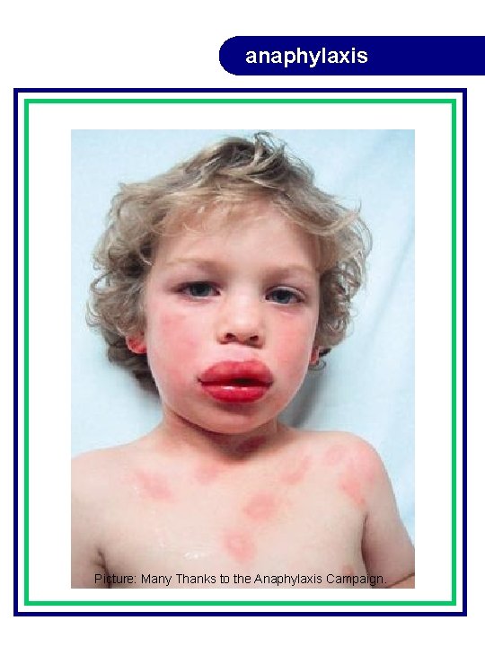 anaphylaxis Picture: Many Thanks to the Anaphylaxis Campaign. anaphylaxis Picture: Many Thanks to the Anaphylaxis Campaign.