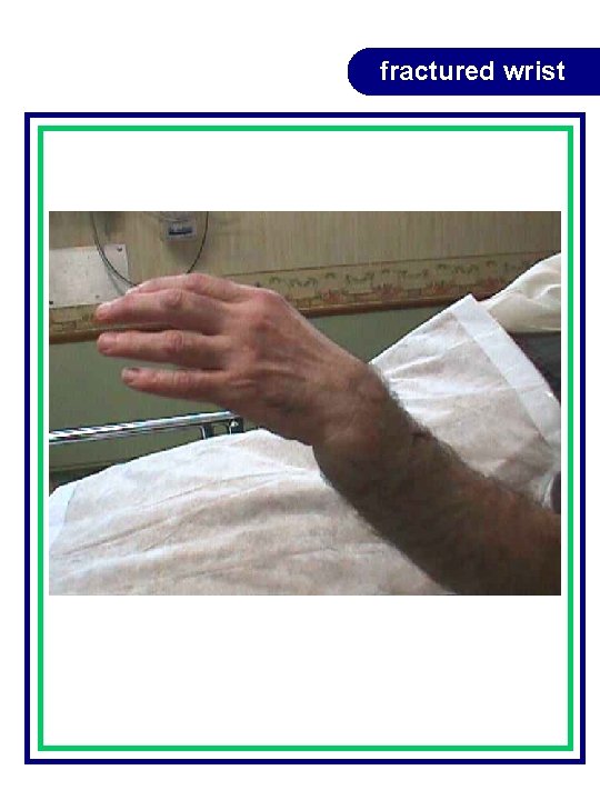 fractured wrist fractured wrist
