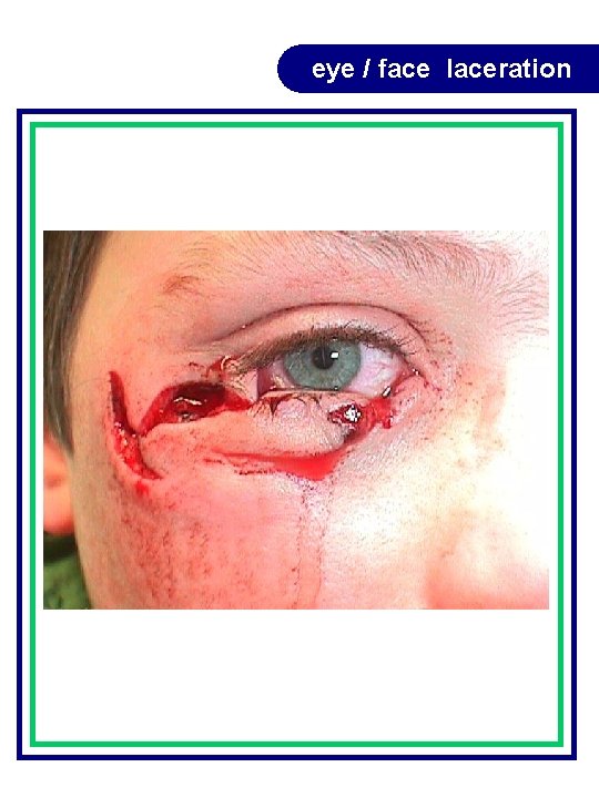 eye / face laceration eye / face laceration