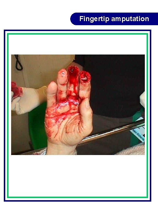 Fingertip amputation Fingertip amputation